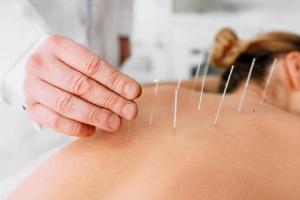 अकुपन्चर के हो ? कसरी काम गर्छ ?